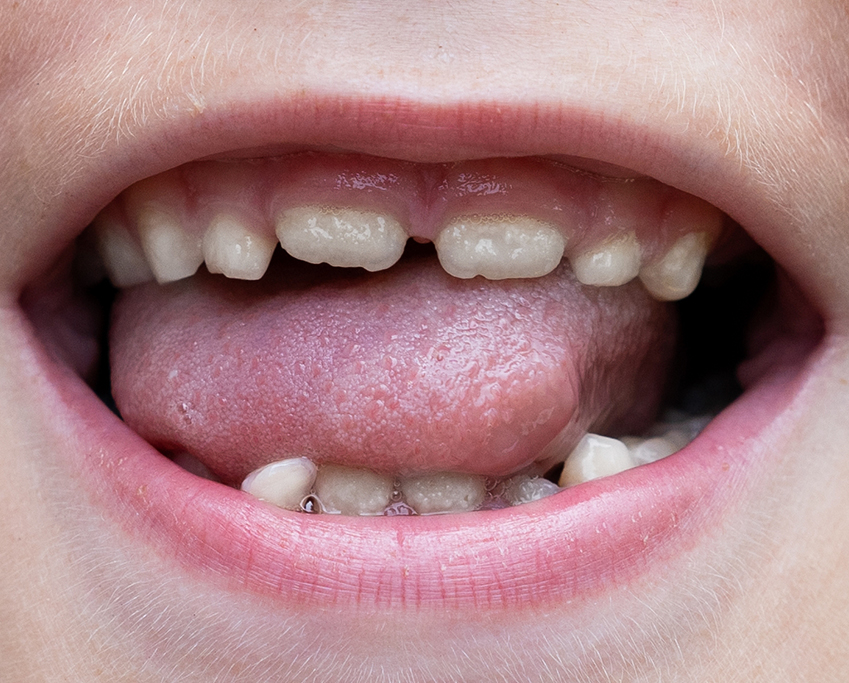 image of infants teeth before invisalign treatment for kids